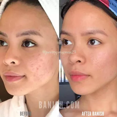BANISH, טיפוח העור הטוב ביותר לצלקות אקנה רגילות : לפני ואחרי הבניש: צלקות אקנה רגילות נעלמו